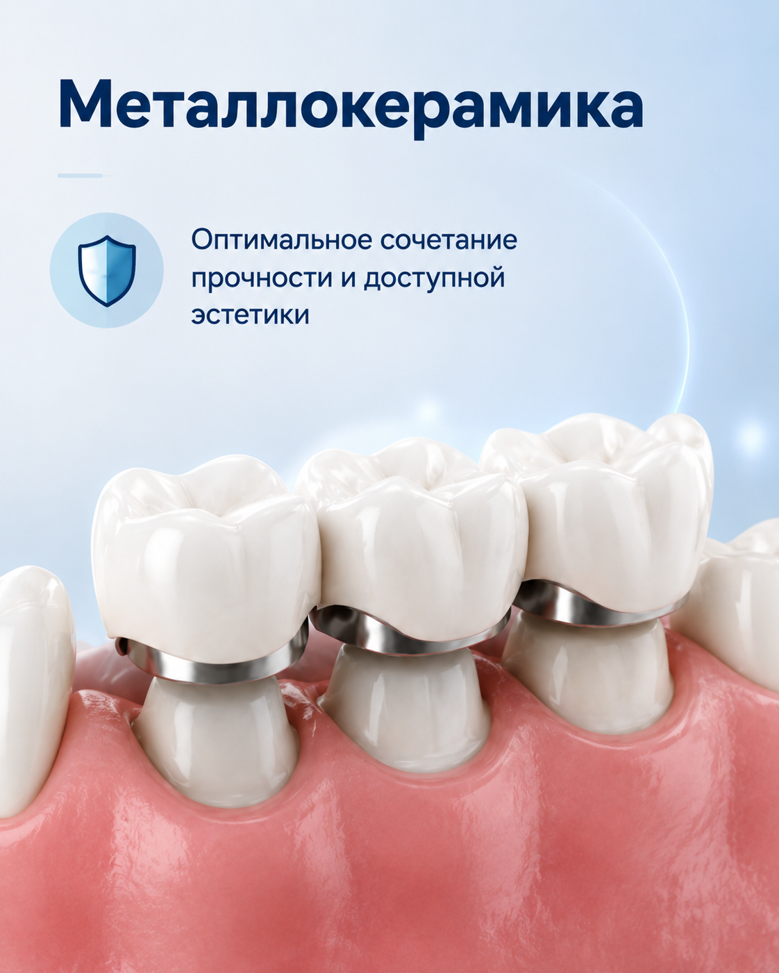Металлокерамика