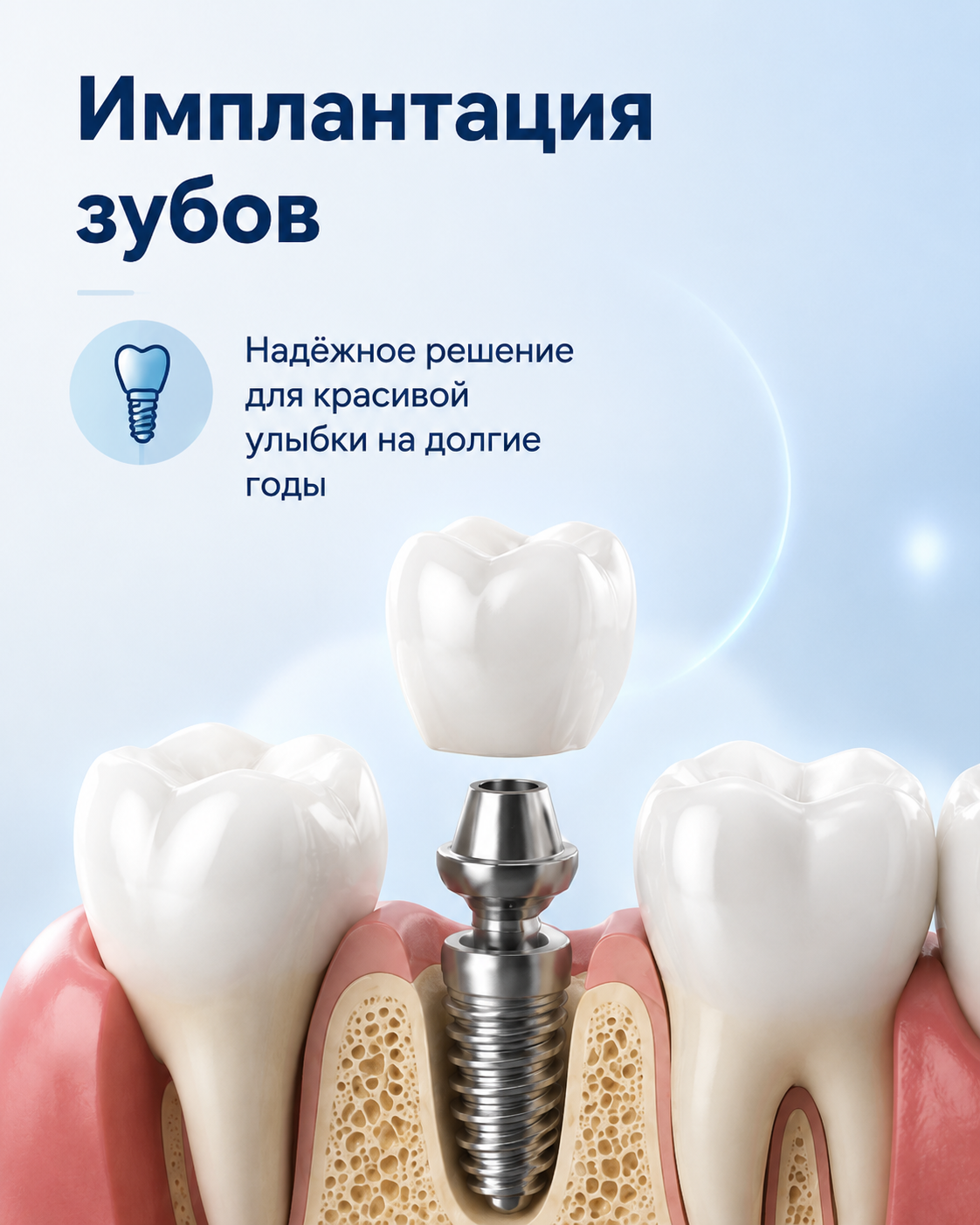Имплантация зубов